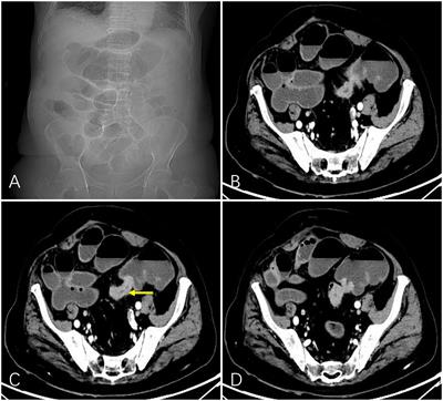 Transcatheter arterial perfusion chemotherapy combined with lipiodol chemoembolization for advanced colorectal cancer complicated by obstruction